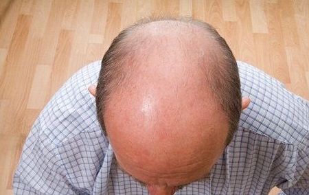 类风湿关节炎药也许可适用于秃头症患者