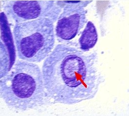 美学者用麻疹病毒“治愈”骨髓瘤