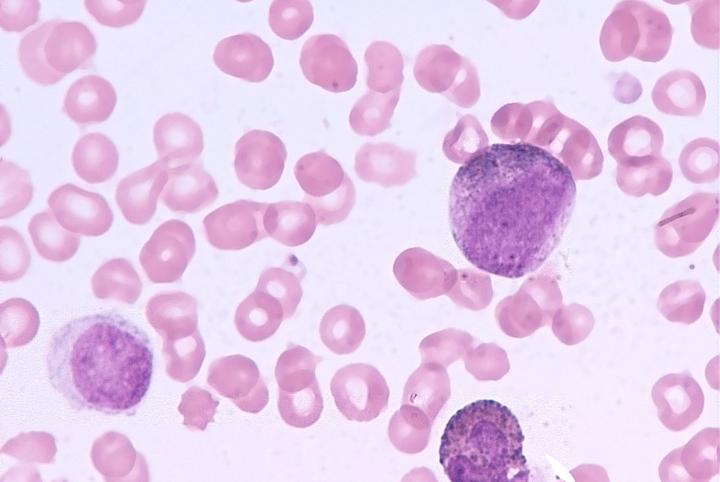 Nature：揭示白血病耐药新机制