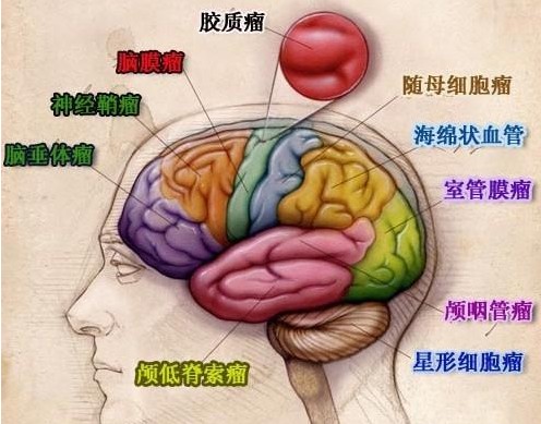 国内外合作首次发现脑干胶质瘤PPM1D基因突变