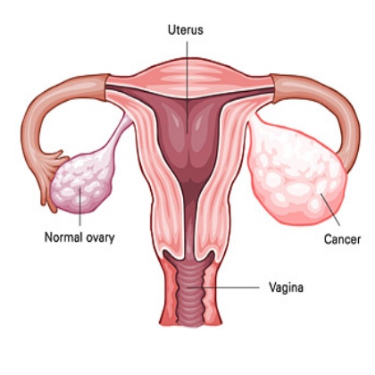 Human Pathology：新型蛋白质或可帮助开发治疗卵巢癌的靶向疗法