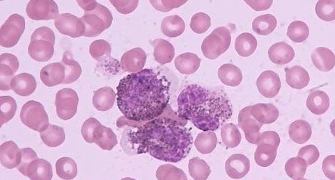 Cancer Res：白血病干细胞的致命弱点