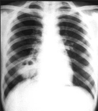 肺脓肿.jpg