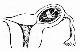 输卵管间质部妊娠