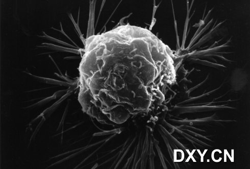 乳腺癌细胞的扫描电子显微照片