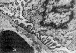 正常肾小球滤过膜