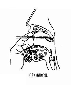 喉镜检查的范围示意图图片