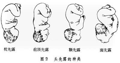 文件:胎儿头先露的种类.jpg - 医学百科