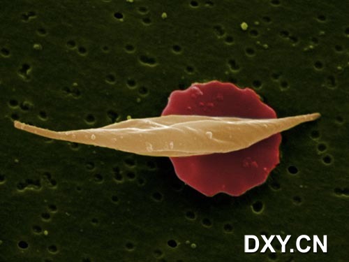 镰状细胞贫血症血红细胞