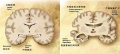 Alzheimer's disease brain comparison.jpg